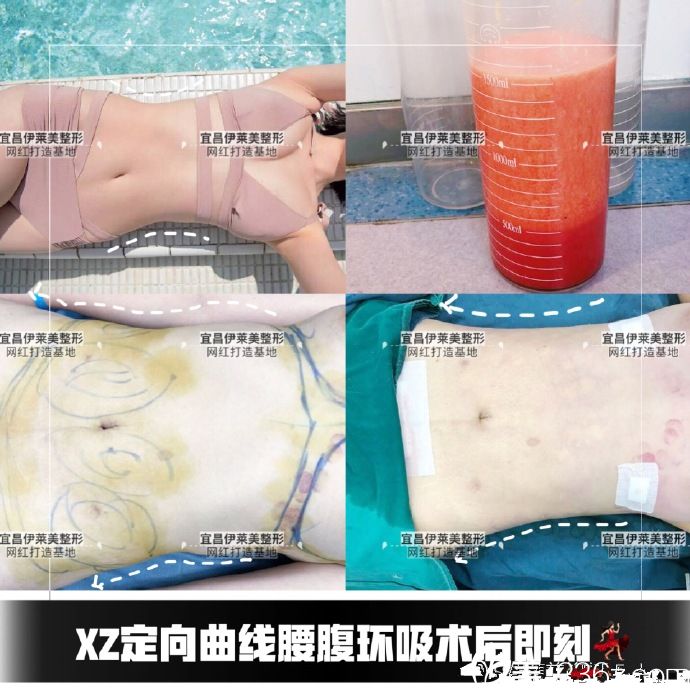 宜昌伊莱美腰腹部吸脂案例 宜昌伊莱美腰腹部吸脂案例