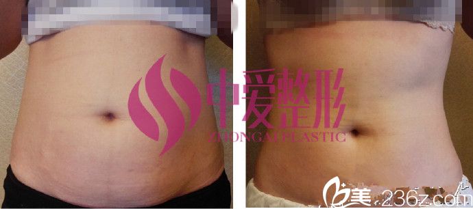 <!--<i data=20240703-sp></li>
<li><i data=20240703-sp></i>-->腰腹部吸脂案例