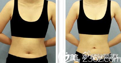 <!--<i data=20240703-sp></li>
                        </a>
                       </ul>
                    </div>
                                        <p>其实冬天还是蛮适合做吸脂的,特别是很难瘦下去的腰腹部,用吸脂可以轻松的瘦下去。那么宜昌伊莱美和做腰腹部吸脂多少钱呢?好奇这两家哪个好的宝宝不妨随着小编一起实地考察</p>
                        <div class=