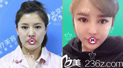 北京雅靓陈林叶医生腰腹吸脂+自体脂肪面部填充案例