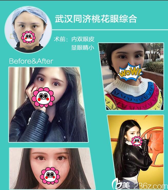 武汉<!--<i data=20240709-sp></i>-->眼综合案例 武汉<!--<i data=20240709-sp></i>-->眼综合案例