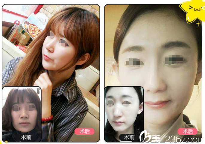 错过双11不要慌，苏州康美12.12整形狂欢项目价格表已出：硅胶隆鼻、内切去眼袋、埋线提升统统只要1980