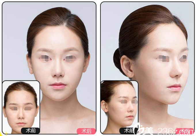 兰州瘦脸案例 兰州瘦脸案例