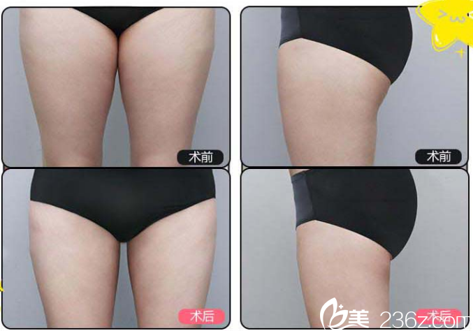 大腿吸脂案例 大腿吸脂案例