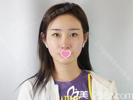 做自体脂肪填充全脸+假体垫下巴术前照 做自体脂肪填充全脸+假体垫下巴术前照