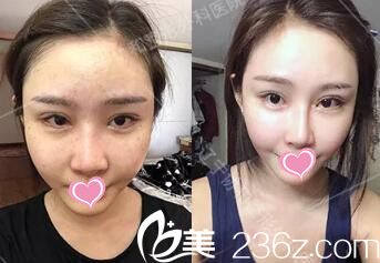 自体脂肪填充全脸术后第7天 自体脂肪填充全脸术后第7天