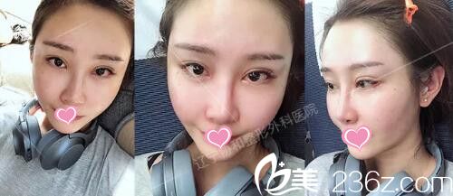 做自体脂肪填充全脸+假体垫下巴术后半个月 做自体脂肪填充全脸+假体垫下巴术后半个月