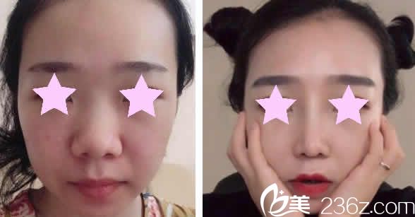 运城华美整形鼻综合整形前后对比图 运城华美整形鼻综合整形前后对比图