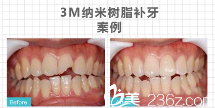 广州利美康口腔医院树脂补牙案例