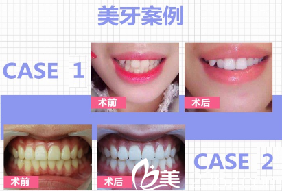 广州利美康口腔医院牙齿美白案例