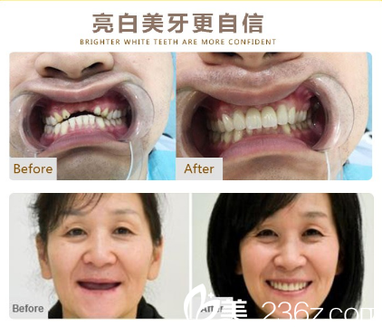 广州利美康牙科医院义齿补牙案例