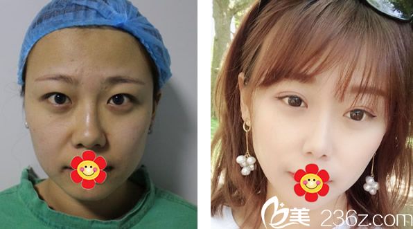 包头叶子冯守运院长全切双眼皮+自体脂肪面部填充效果 包头叶子冯守运院长全切双眼皮+自体脂肪面部填充效果