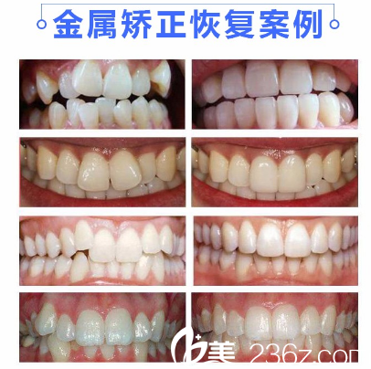 广州利美康口腔医院金属托槽牙齿矫正案例