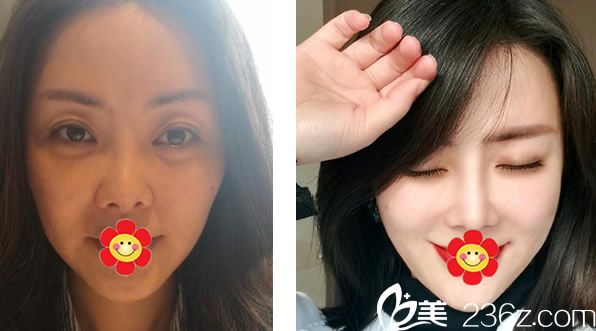 包头叶子彭栋梁医生假体隆鼻+自体软骨隆鼻+面部线雕三个月效果对比案例 包头叶子彭栋梁医生假体隆鼻+自体软骨隆鼻+面部线雕三个月效果对比案例