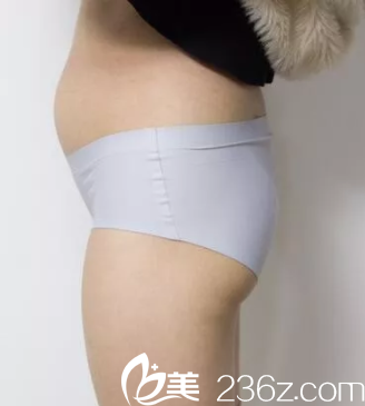 在北京雅靓做水动力腰腹吸脂前样子 在北京雅靓做水动力腰腹吸脂前样子