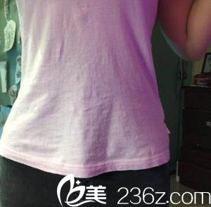 在北京雅靓做水动力腰腹吸脂第24天效果 在北京雅靓做水动力腰腹吸脂第24天效果