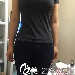 北京雅靓张春彦水动力腰腹吸脂案例 北京雅靓张春彦水动力腰腹吸脂案例