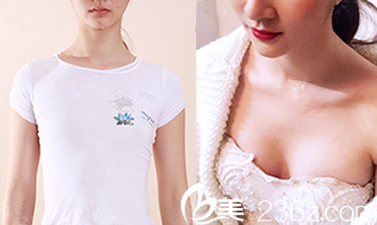 重庆隆胸哪家好?看重庆华美陈德法<span style= 重庆隆胸哪家好?看重庆华美陈德法<span style=