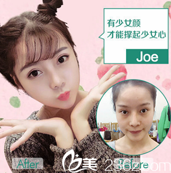 脂肪填充面部案例 脂肪填充面部案例