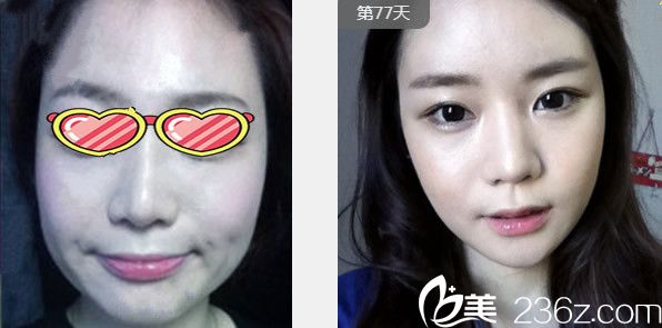 兰州崔娟大夫下颌角整形效果案例 兰州崔娟大夫下颌角整形效果案例