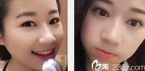 兰州仁和切开双眼皮+开眼角效果 兰州仁和切开双眼皮+开眼角效果