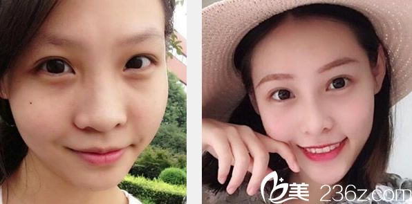 兰州仁和自体软骨隆鼻+全脸脂肪填充案例 兰州仁和自体软骨隆鼻+全脸脂肪填充案例