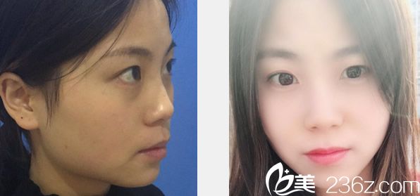 兰州仁和整形医院瘦脸除皱瘦脸及光子嫩肤效果 兰州仁和整形医院瘦脸除皱瘦脸及光子嫩肤效果