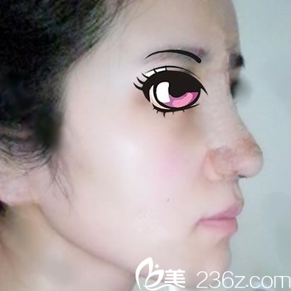 做完鼻综合隆鼻手术3天照 做完鼻综合隆鼻手术3天照