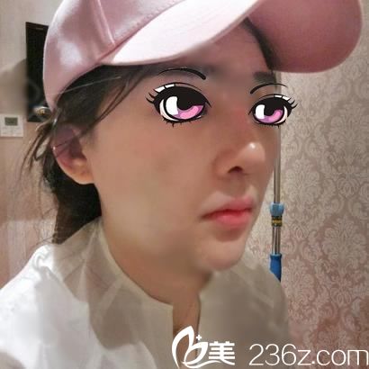 宁波尚丽鼻综合7天图 宁波尚丽鼻综合7天图