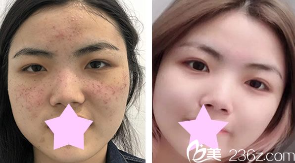 美莱李大铁院长祛斑效果对比图