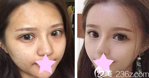 美莱宋萍院长自体脂肪面部填充效果对比图