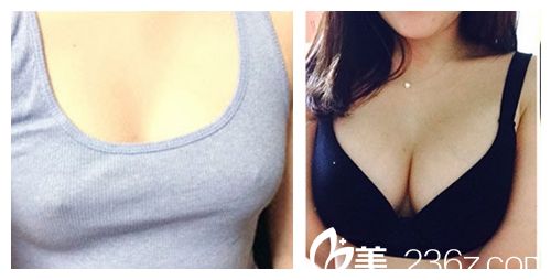 韩国ID医院无痛假体隆胸术前术后对比图 韩国ID医院无痛假体隆胸术前术后对比图