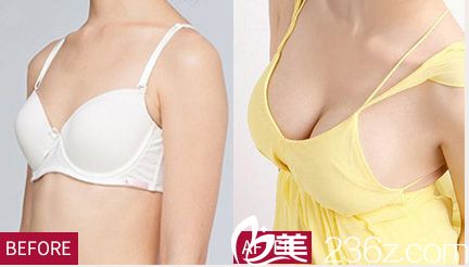 医生隆胸案例 医生隆胸案例