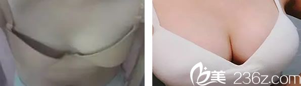 医生自体脂肪隆胸案例