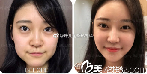 瘦脸多少钱？双12芜湖珠儿丽整形优惠价格表公布，其中瘦脸680元起