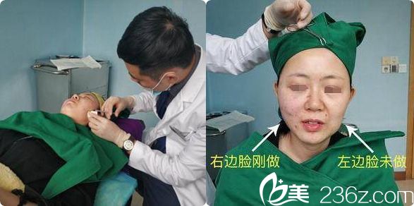 线雕提升手术中及即刻效果