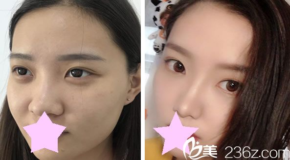 段瑞平医生线雕隆鼻效果对比图