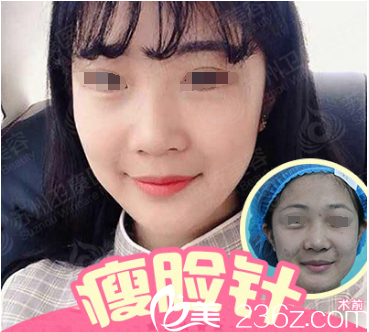 国产兰州瘦脸除皱瘦脸案例 国产兰州瘦脸除皱瘦脸案例