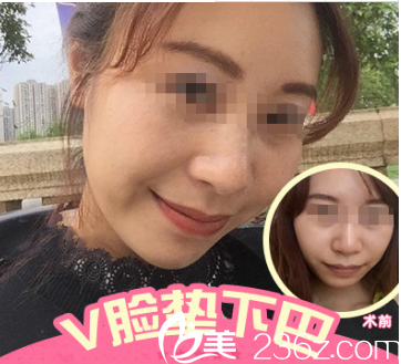 硅胶垫下巴案例 硅胶垫下巴案例