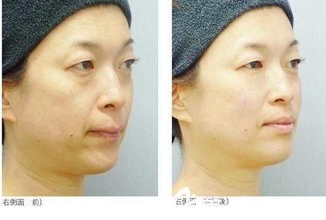 青山エルクリニック玻尿酸注射 青山エルクリニック玻尿酸注射