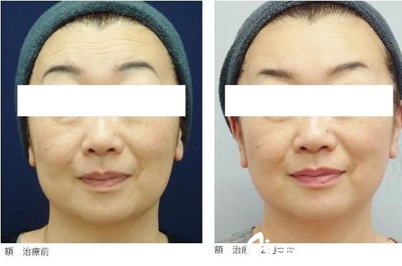 青山エルクリニック瘦脸除皱去皱 青山エルクリニック瘦脸除皱去皱