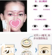 全切双眼皮手术示意图 全切双眼皮手术示意图