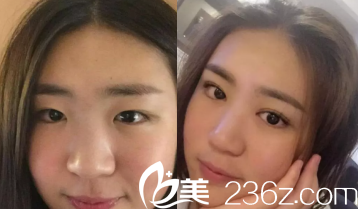 邢学斌医生眼部整形案例 邢学斌医生眼部整形案例