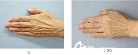 杉野宏子玻尿酸注射 杉野宏子玻尿酸注射