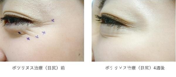 杉野宏子瘦脸除皱注射 杉野宏子瘦脸除皱注射