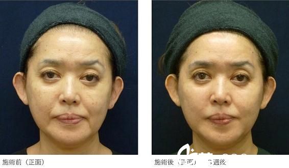 杉野宏子面部拉皮 杉野宏子面部拉皮