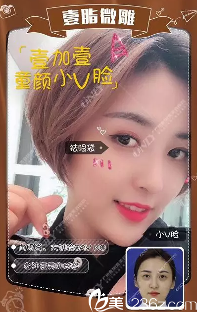 广州壹加壹自体脂肪全脸填充实例