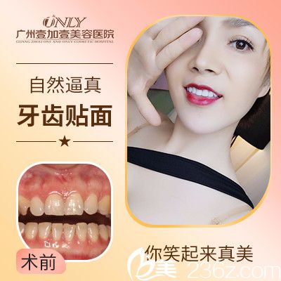 广州壹加壹做的牙齿瓷贴面实例