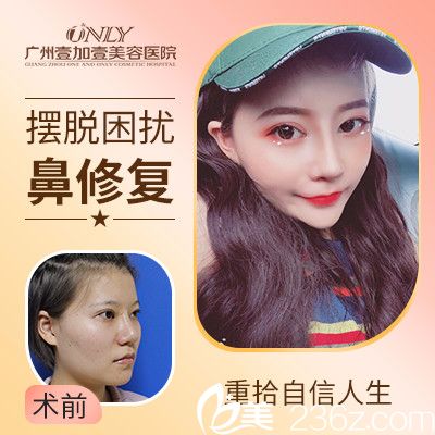 广州壹加壹李明做的隆鼻失败修复实例