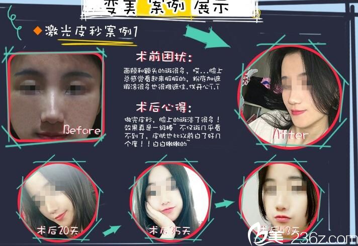 武汉亚韩蜂巢皮秒案例 武汉亚韩蜂巢皮秒案例